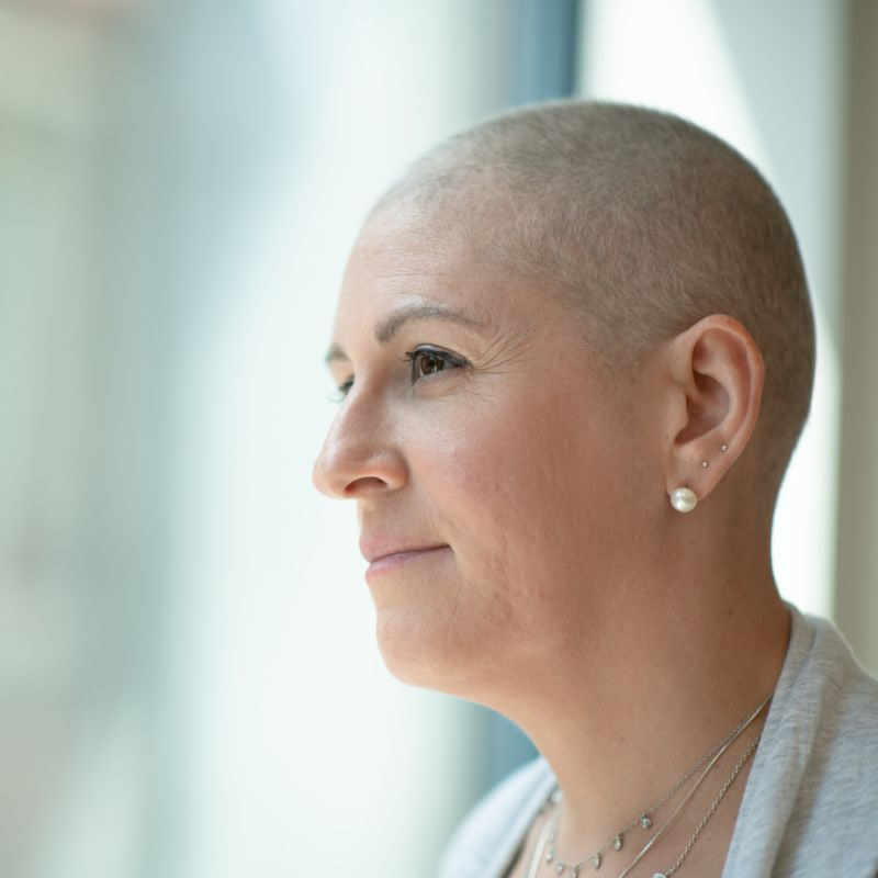 Woman with hair loss after cancer treatment